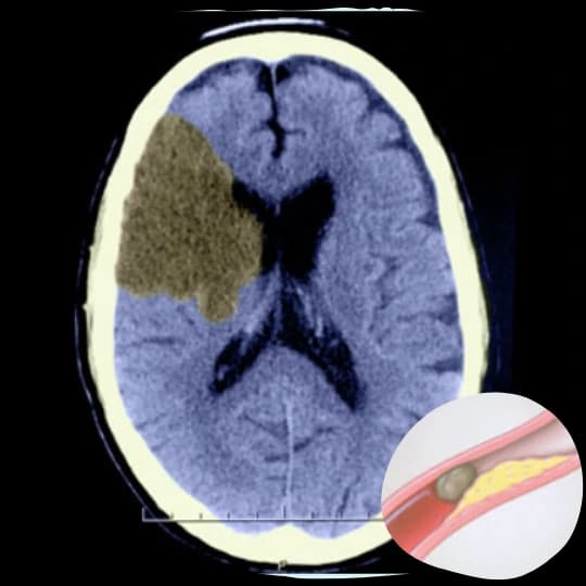 CT scan illustrating an ischemic stroke